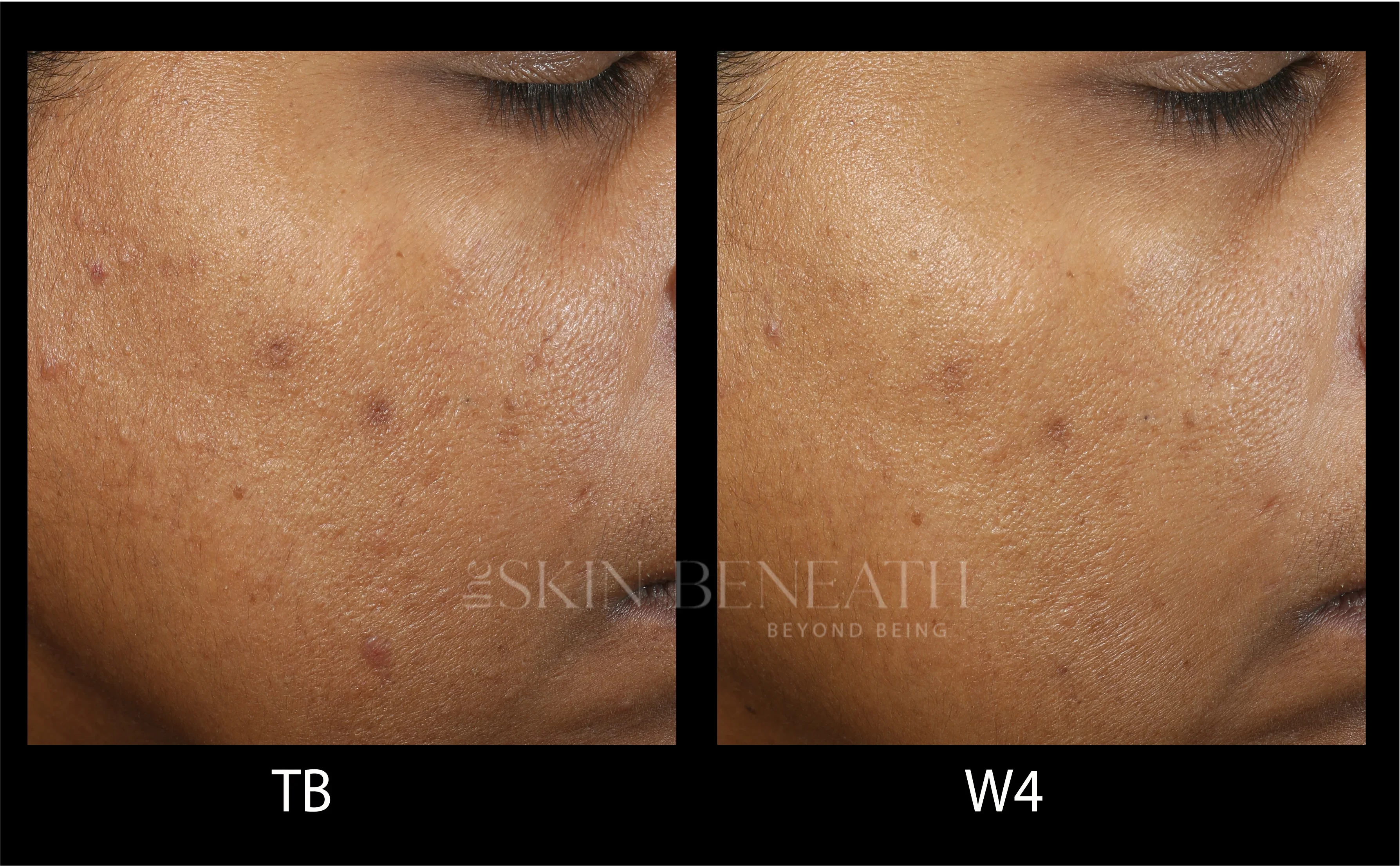 Hyperpigmentation improvement in melanin-rich skin