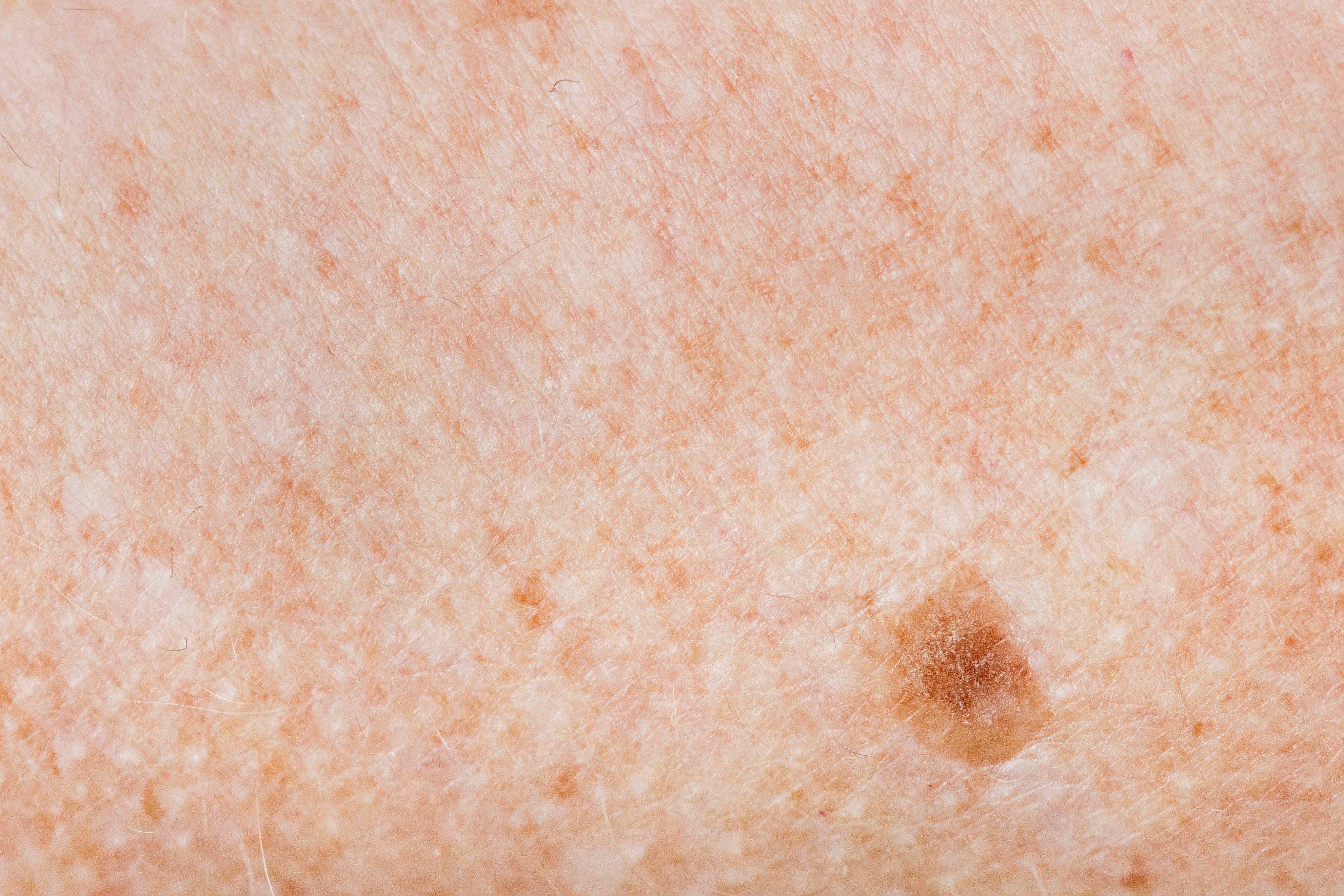 Close-up of skin showing a dark spot and pigmentation marks — illustrating hyperpigmentation on skin