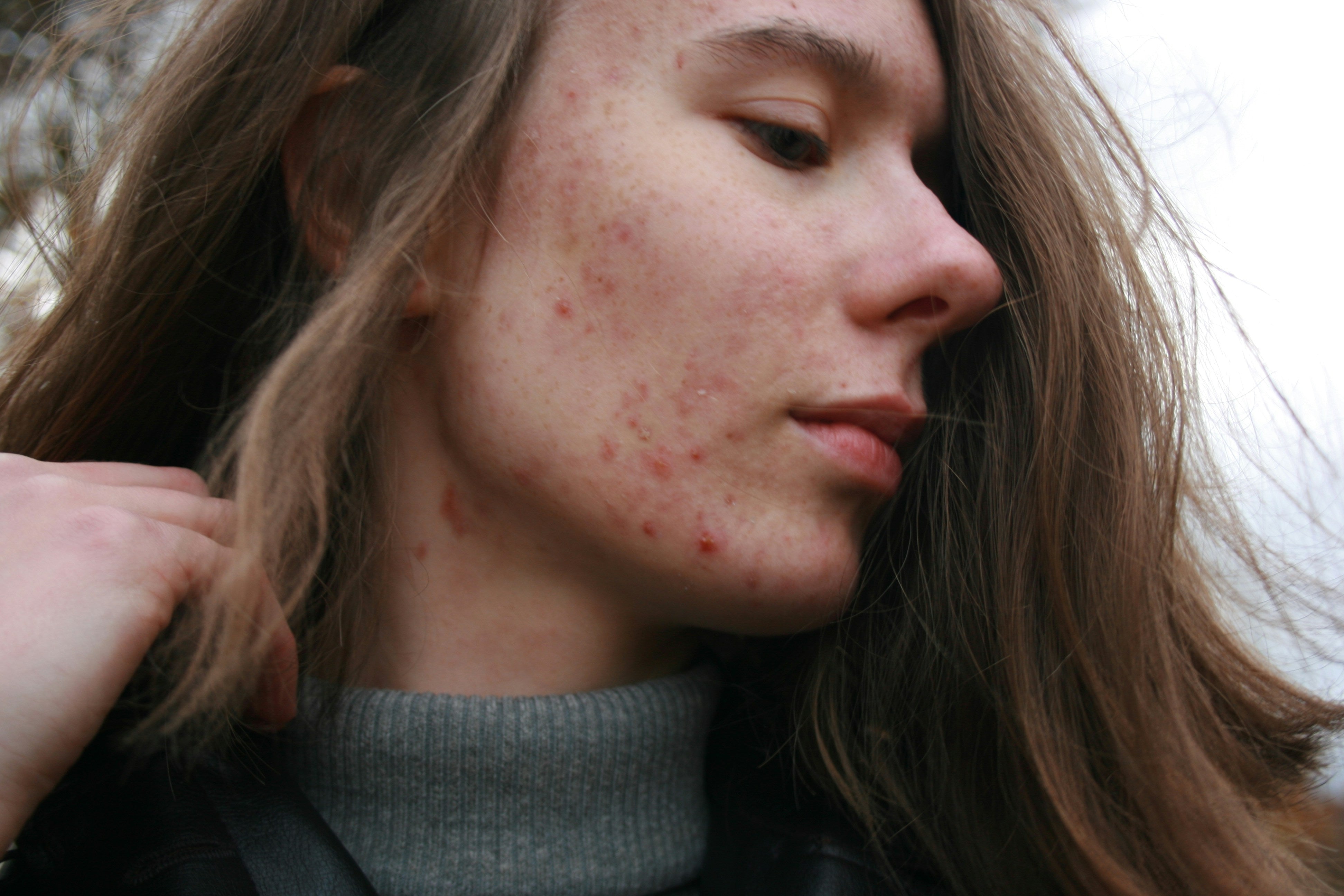 Is Your Cleanser Causing Skin Sensitivity - The Skinbeneath
