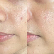 Skin close-up showing improvement in post-acne marks and uneven skin tone with Fika pigmentation serum