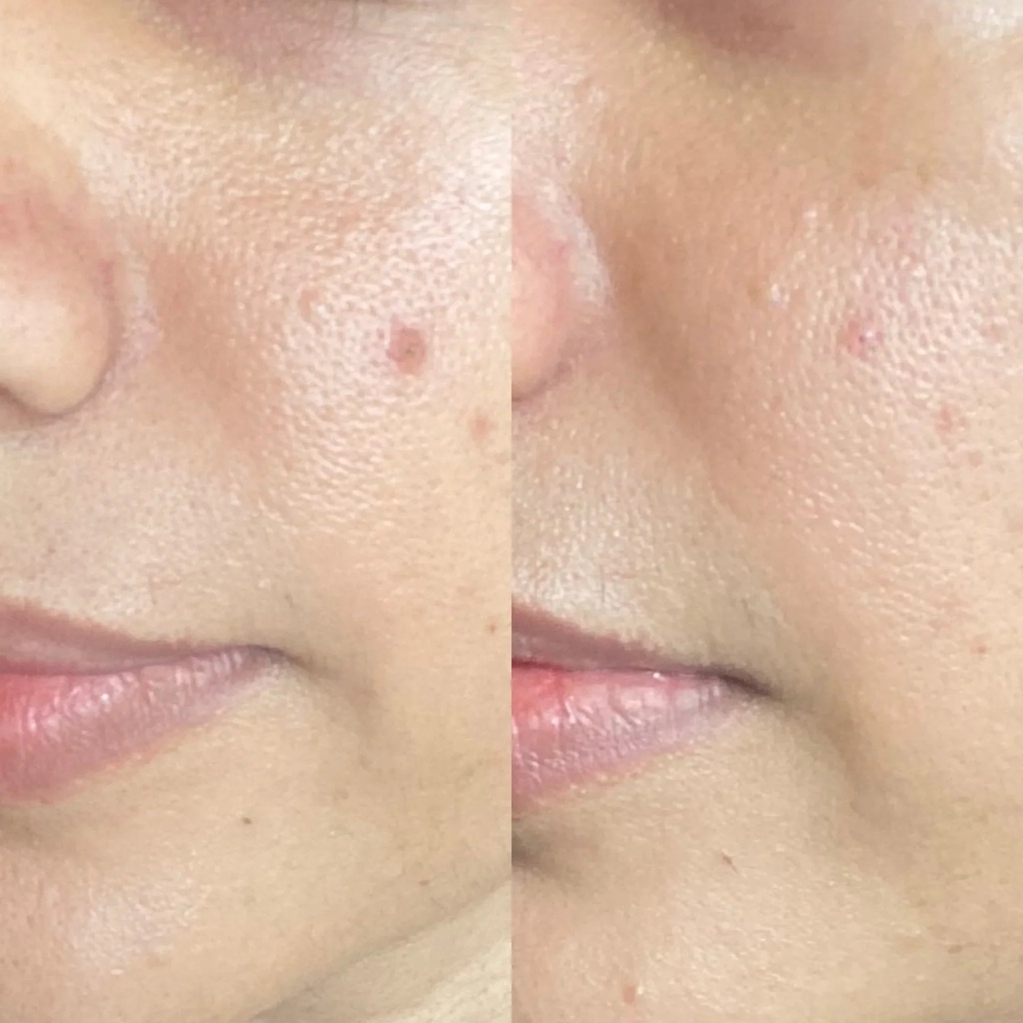 Skin close-up showing improvement in post-acne marks and uneven skin tone with Fika pigmentation serum