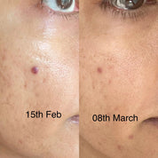 Before and after results showing improvement in pigmentation appearance with Fika pigmentation serum
