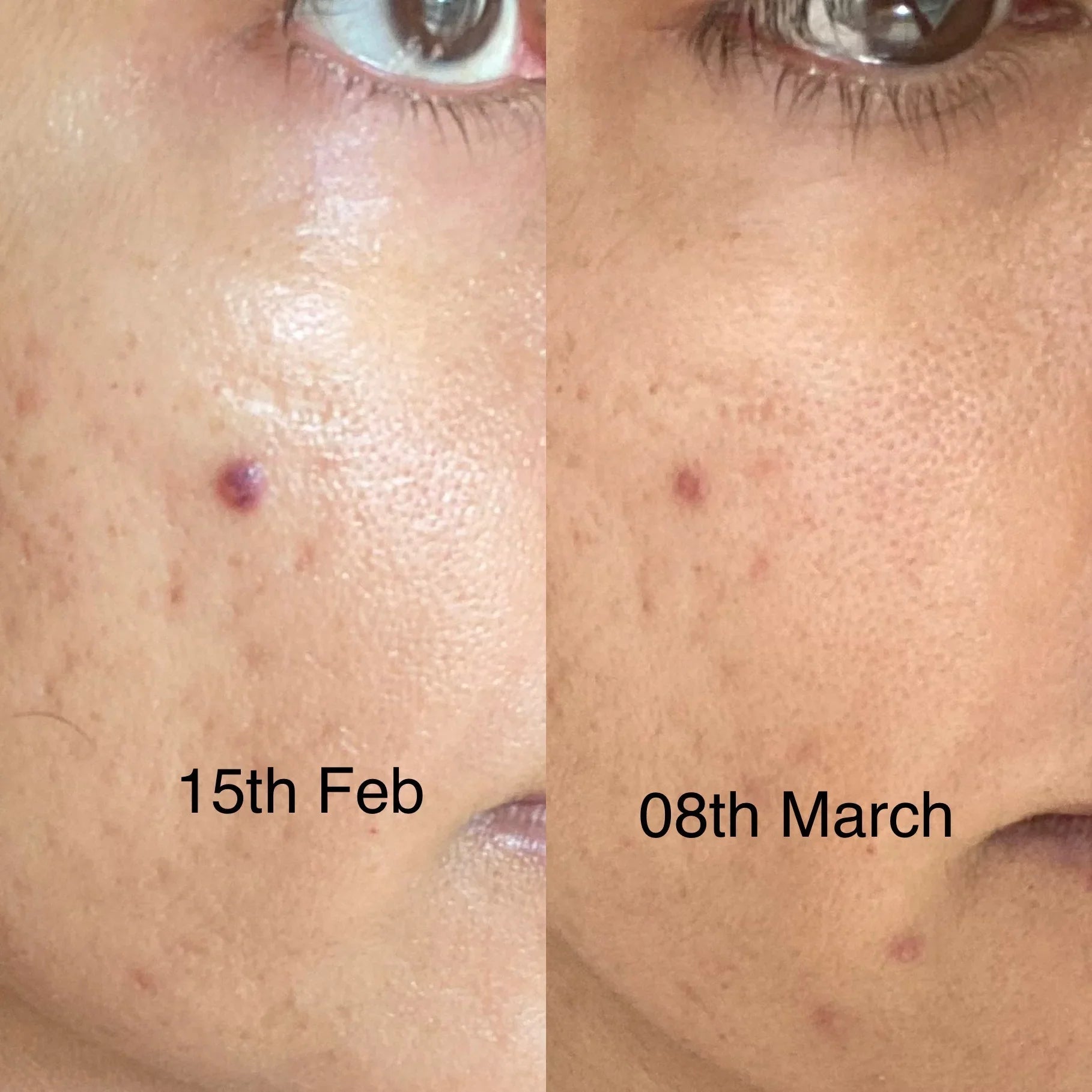 Before and after results showing improvement in pigmentation appearance with Fika pigmentation serum
