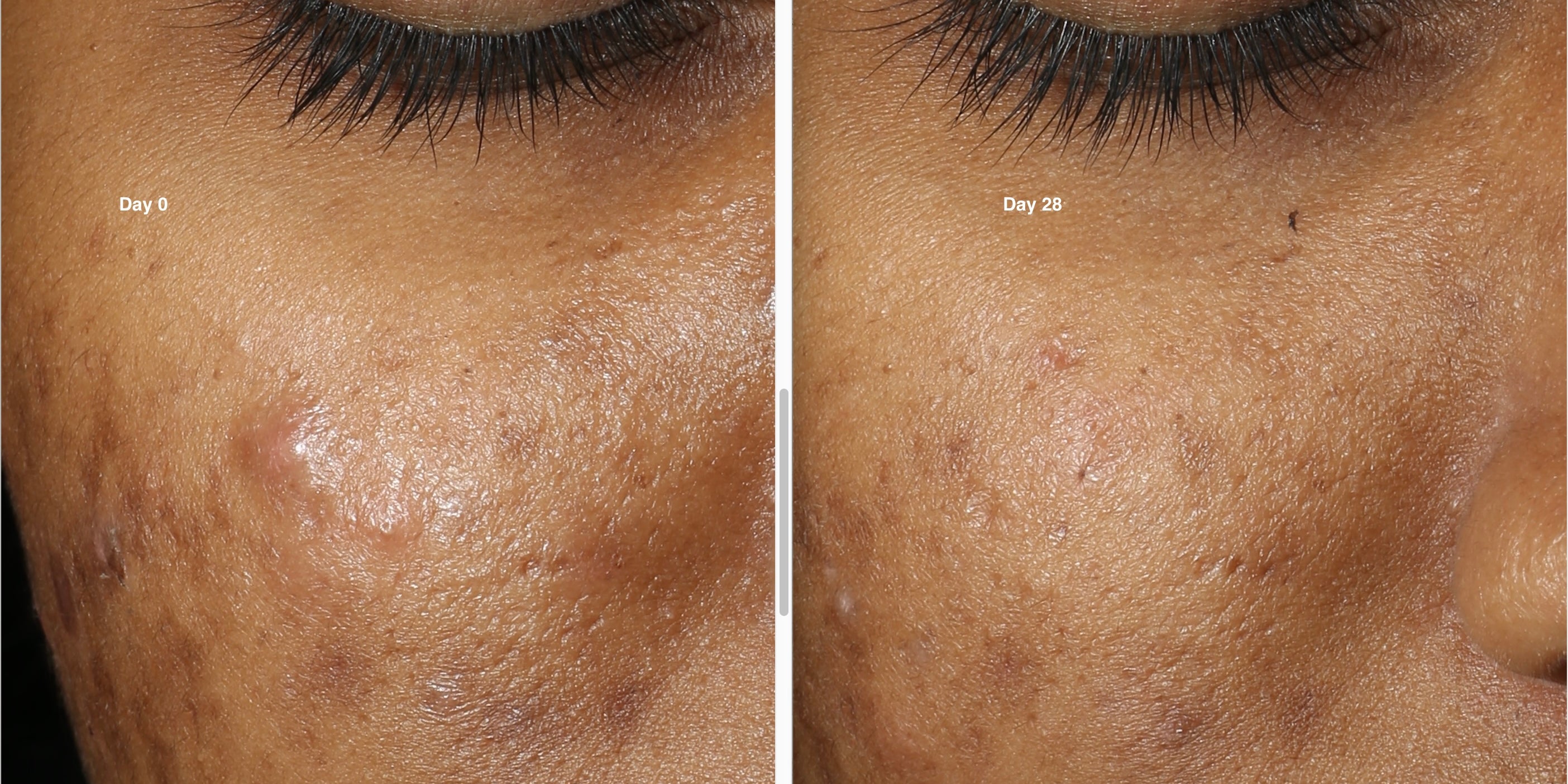 left_over_dark_spots_and_acne_marks.jpg