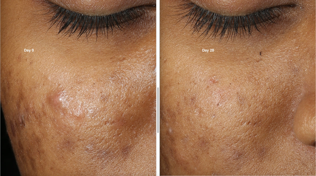 Benth Skin The Skin Beneath — Pigmentation & Barrier Serums for Indian Skin